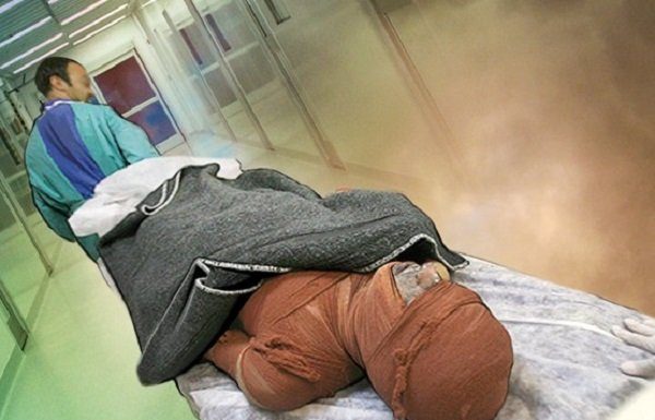 کمبود هزار تخت بیمارستانی سوختگی در کشور – خبرگزاری مهر | اخبار ایران و جهان