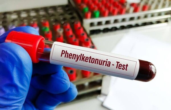 خبر خوش برای بیماران PKU؛ توزیع نان فاقد پروتئین – خبرگزاری مهر | اخبار ایران و جهان